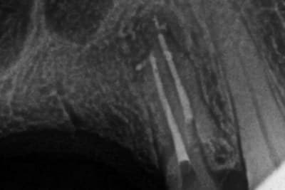 Dente 14, radiografia final