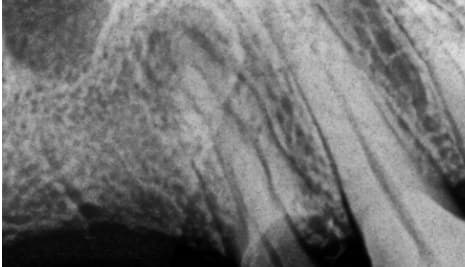 Dente 14, radiografia inicial