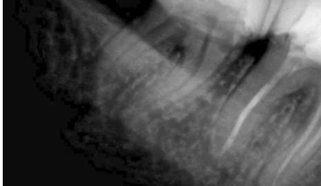 Dente 47, radiografia inicial